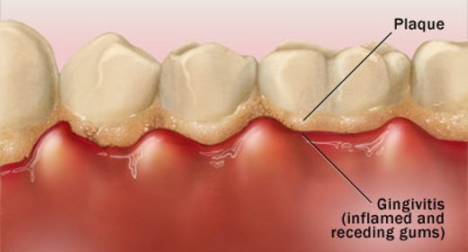 What is dental plaque?